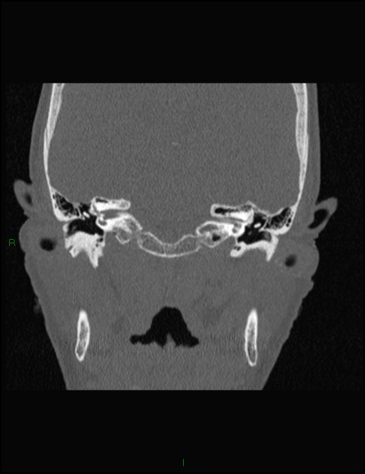 Bilateral frontal mucoceles (Radiopaedia 82352-96454 Coronal 300).jpg