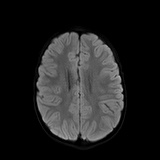 File:Bilateral mesial temporal polymicrogyria (Radiopaedia 76456-88181 Axial DWI 41).jpg