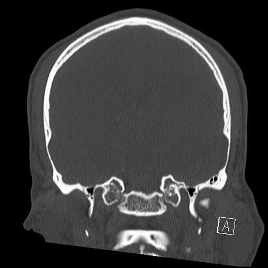 Bilateral occipital condyle fracture (type 2) (Radiopaedia 87675-104089 Coronal bone window 68).jpg