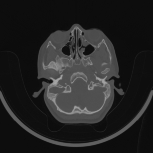 Bilateral otosclerosis (Radiopaedia 57237-64157 C 23).jpg