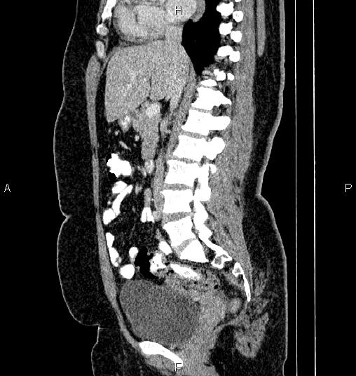 Bilateral ovarian dermoid cysts (Radiopaedia 85785-101603 D 41).jpg