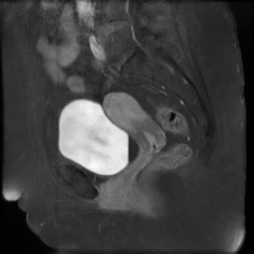 File:Bilateral ovarian dermoid cysts (Radiopaedia 90152-107338 Sagittal T1 C+ 14).jpg