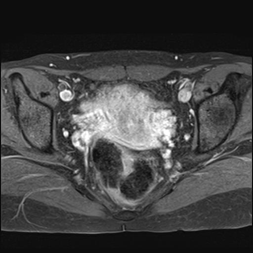 File:Bilateral ovarian endometriomas (Radiopaedia 87085-103347 Axial T1 C+ fat sat 13).jpg