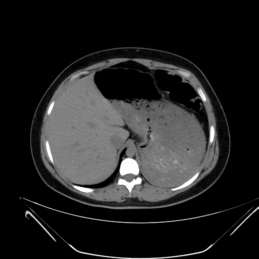 File:Bilateral ovarian mature cystic teratomas (Radiopaedia 79373-92457 Axial non-contrast 4).jpg