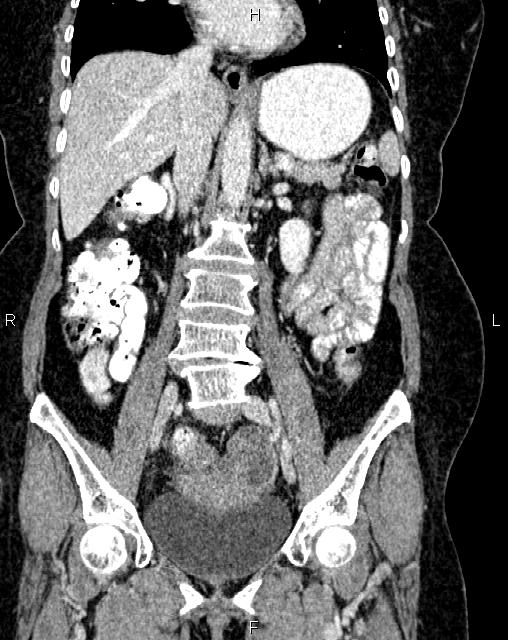 Bilateral ovarian serous cystadenocarcinoma (Radiopaedia 86062-101989 D 24).jpg