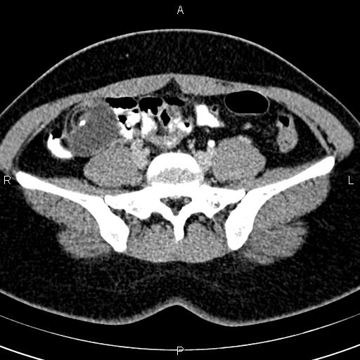 File:Bilateral ovarian teratoma (Radiopaedia 83131-97503 B 15).jpg