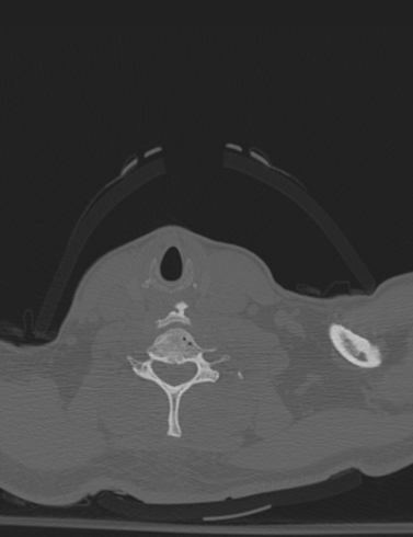 Bilateral perched facet joint (Radiopaedia 63149-71669 Axial bone window 50).jpg