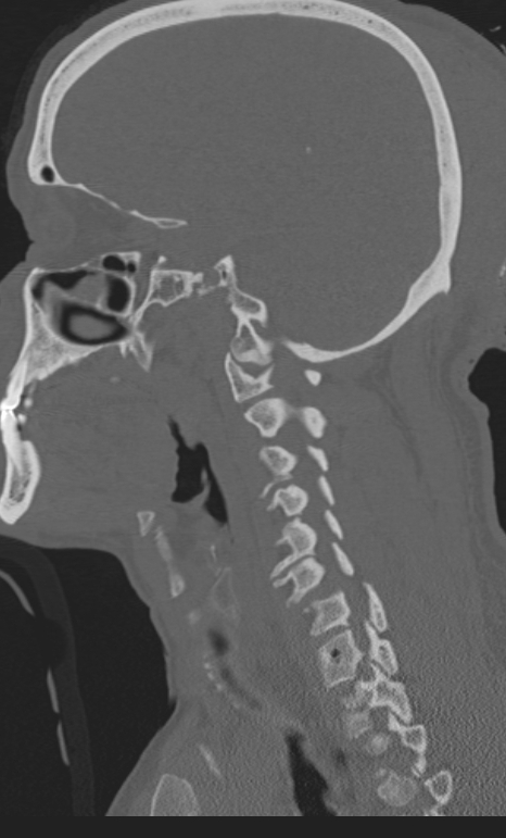 Bilateral perched facet joint (Radiopaedia 63149-71669 Sagittal bone window 46).jpg