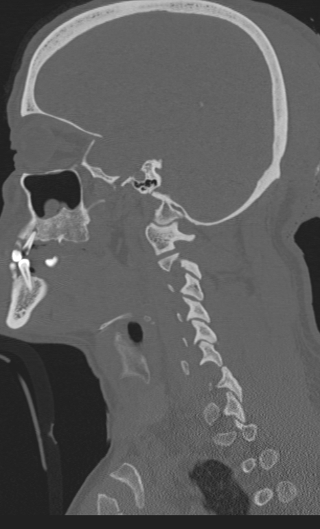 Bilateral perched facet joint (Radiopaedia 63149-71669 Sagittal bone window 56).jpg