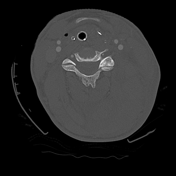 File:Bilateral perched facets with cord injury (Radiopaedia 45587-49713 Axial bone window 53).jpg
