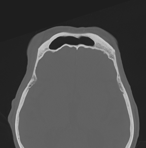 File:Bilateral preseptal periorbital cellulitis (Radiopaedia 43081-46350 Axial bone window 8).png