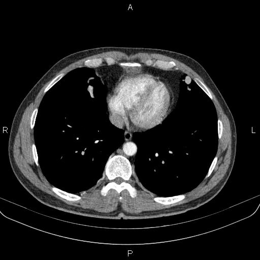 Bilateral pulmonary AVM (Radiopaedia 83134-97505 A 52).jpg