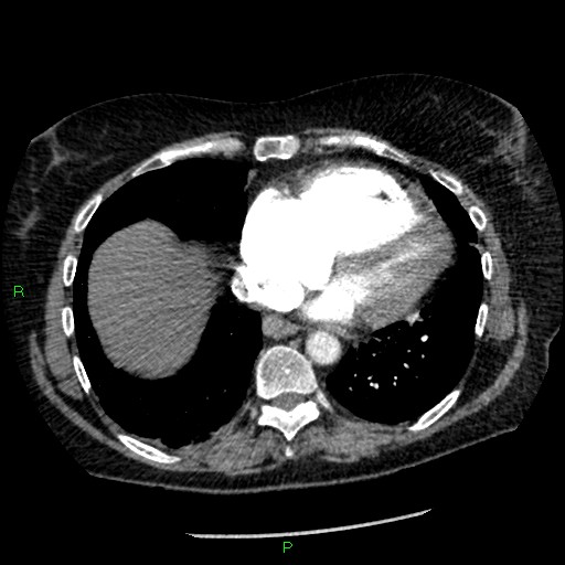 Bilateral pulmonary emboli (Radiopaedia 32700-33669 Axial C+ CTPA 79).jpg