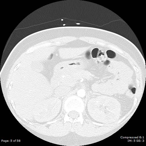 Bilateral pulmonary emboli with Hampton hump sign (Radiopaedia 54070-60246 Axial lung window 5).jpg