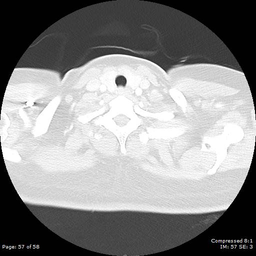 Bilateral pulmonary emboli with Hampton hump sign (Radiopaedia 54070-60246 Axial lung window 57).jpg