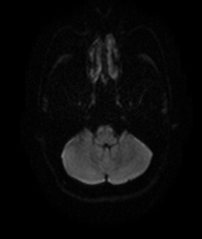 File:Bilateral thalamic gliomata (Radiopaedia 42538-45664 Axial DWI 5).jpg