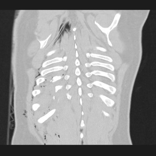 Bilateral traumatic renovascular injury (Radiopaedia 32051-32995 Coronal lung window 71).jpg
