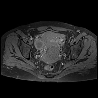 Bilateral tubo-ovarian abscesses (Radiopaedia 58635-65829 Axial T1 fat sat 26).jpg