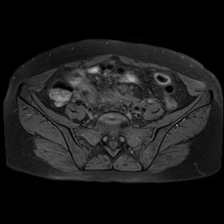 Bilateral tubo-ovarian abscesses (Radiopaedia 58635-65829 Axial T1 fat sat 6).jpg