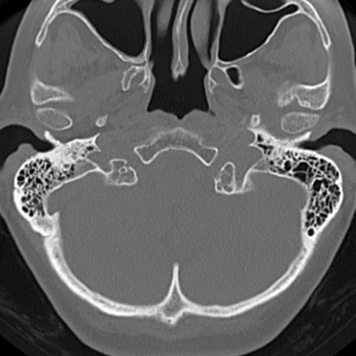 File:Bilateral tympanoplasty (Radiopaedia 16947-16664 Axial bone window 24).jpg