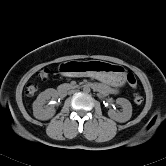 Bilateral ureteric stents (Radiopaedia 48795-53825 Axial non-contrast 25).jpg