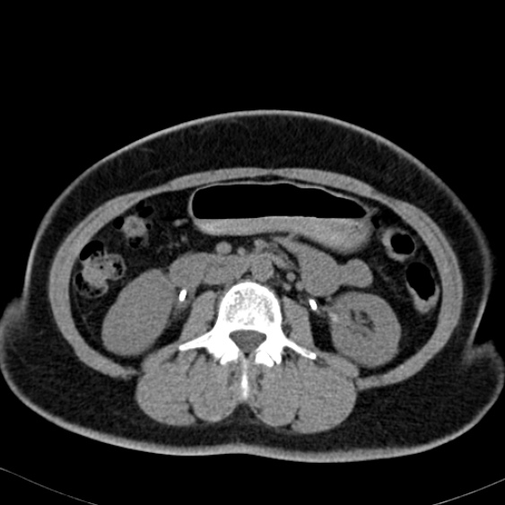 File:Bilateral ureteric stents (Radiopaedia 48795-53825 Axial non-contrast 27).jpg
