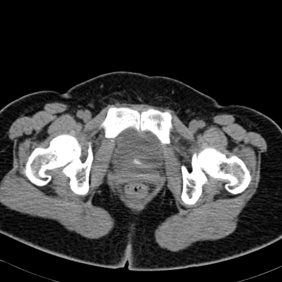 Bilateral ureteric stents (Radiopaedia 48795-53825 Axial non-contrast 68).jpg
