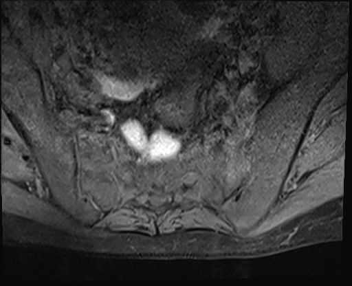 File:Bing-Neel syndrome (Radiopaedia 71453-81799 Axial T1 fat sat 20).jpg