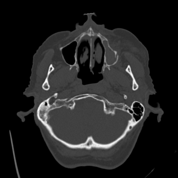 Biparietal osteodystrophy (Radiopaedia 46109-50463 bone window 11).jpg