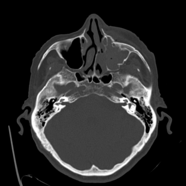 Biparietal osteodystrophy (Radiopaedia 46109-50463 bone window 20).jpg