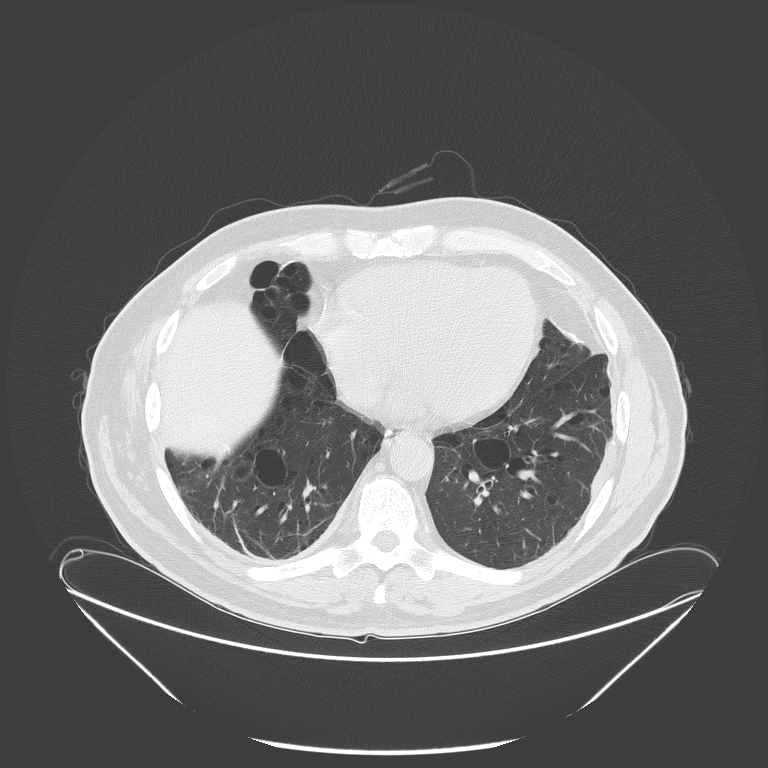 Birt-Hogg-Dubé syndrome (Radiopaedia 52578-58491 Axial lung window 43).jpg