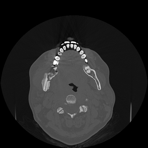 File:Bisphosphonate-related osteonecrosis of the jaw (Radiopaedia 71324-81642 Axial bone window 69).jpg