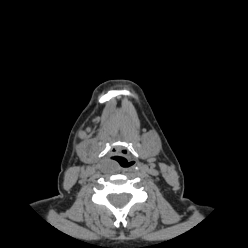 Bisphosphonate-related osteonecrosis of the jaw (Radiopaedia 71324-81642 non-contrast 11).jpg
