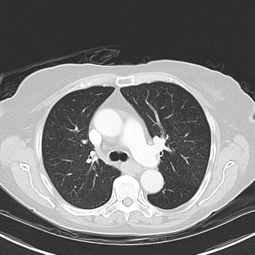 File:Bladder and bowel cancers (Radiopaedia 37688-39592 Axial lung window 21).png