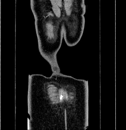 Blind-ending branch of a bifid ureter (Radiopaedia 61159-69048 C 71).jpg