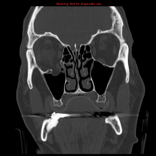 File:Blowout fracture with inferior rectus entrapment (Radiopaedia 12418-12673 Coronal bone window 8).jpg