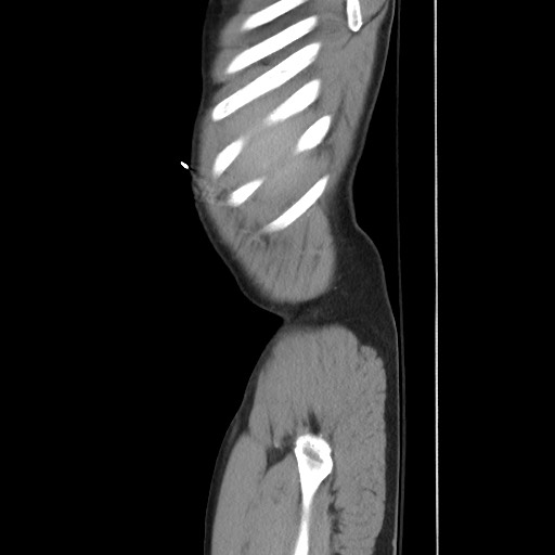 Blunt abdominal trauma with solid organ and musculoskelatal injury with active extravasation (Radiopaedia 68364-77895 C 22).jpg