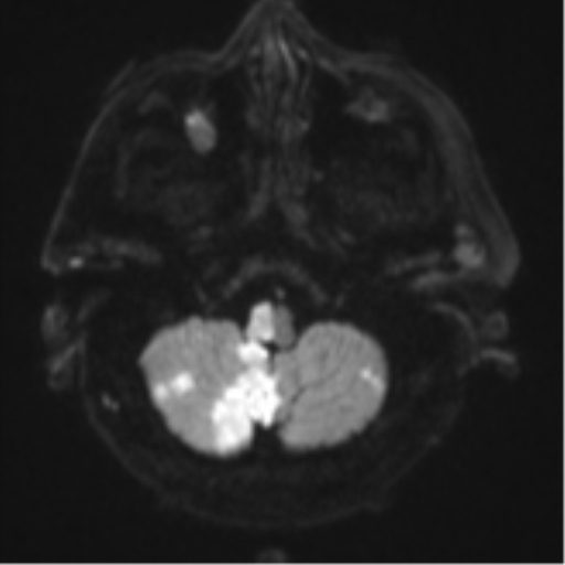 Blunt cerebrovascular injury (Radiopaedia 53682-59745 Axial DWI 36).png