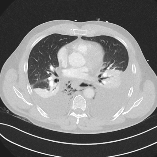Boerhaave syndrome (Radiopaedia 39382-41660 Axial lung window 30).png