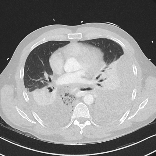 Boerhaave syndrome (Radiopaedia 39382-41661 Axial lung window 31).png