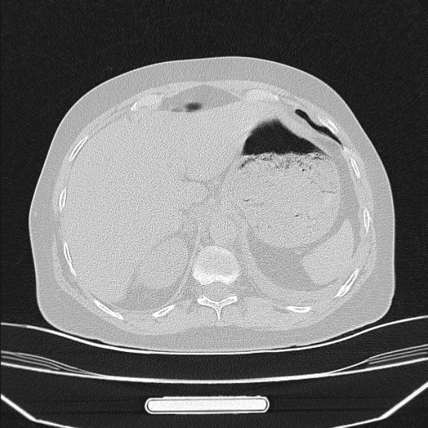 Boerhaave syndrome (Radiopaedia 45644-49799 Axial lung window 101).jpg