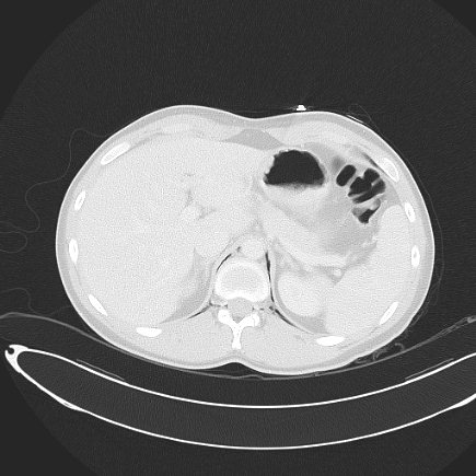 File:Boerhaave syndrome with mediastinal, axillary, neck and epidural free gas (Radiopaedia 41297-44115 Axial lung window 81).jpg