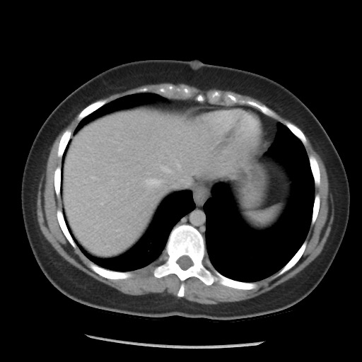 File:Borderline mucinous tumor (ovary) (Radiopaedia 78228-90808 A 65).jpg