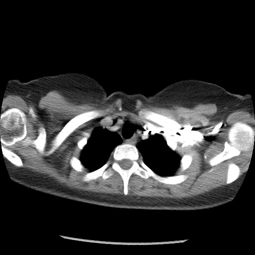 File:Borderline mucinous tumor (ovary) (Radiopaedia 78228-90808 A 7).jpg