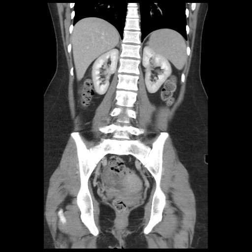 Borderline mucinous tumor (ovary) (Radiopaedia 78228-90808 C 35).jpg