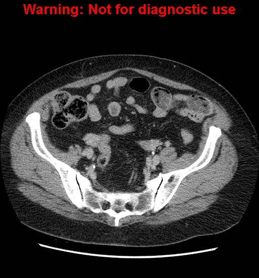 File:Bosniak renal cyst - type II (Radiopaedia 23404-23468 F 50).jpg