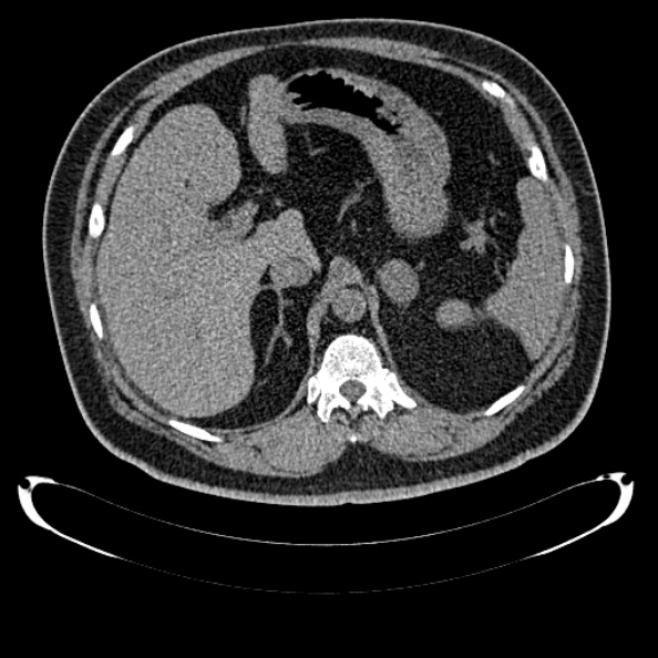 Bosniak renal cyst - type IV (Radiopaedia 24244-24518 Axial non-contrast 111).jpg