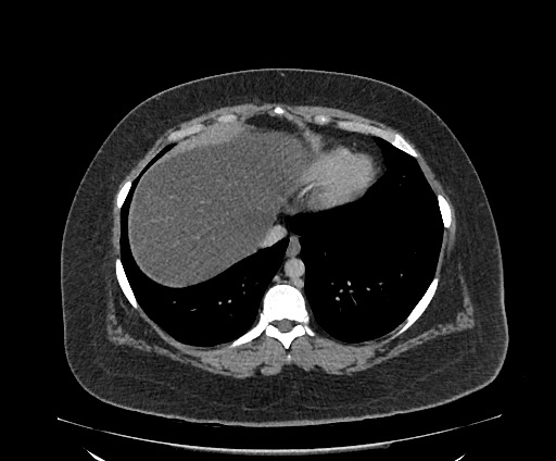 File:Bowel and splenic infarcts in acute lymphocytic leukemia (Radiopaedia 61055-68913 A 18).jpg
