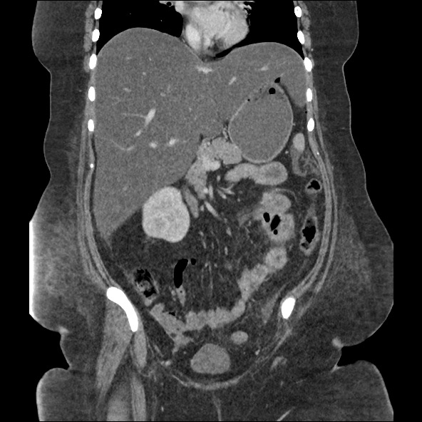 Bowel and splenic infarcts in acute lymphocytic leukemia (Radiopaedia 61055-68915 B 30).jpg