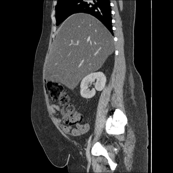 Bowel and splenic infarcts in acute lymphocytic leukemia (Radiopaedia 61055-68915 C 45).jpg